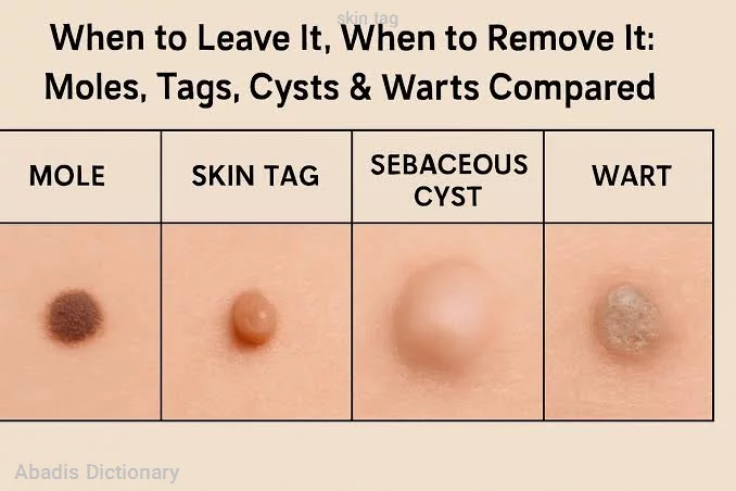 skin tag